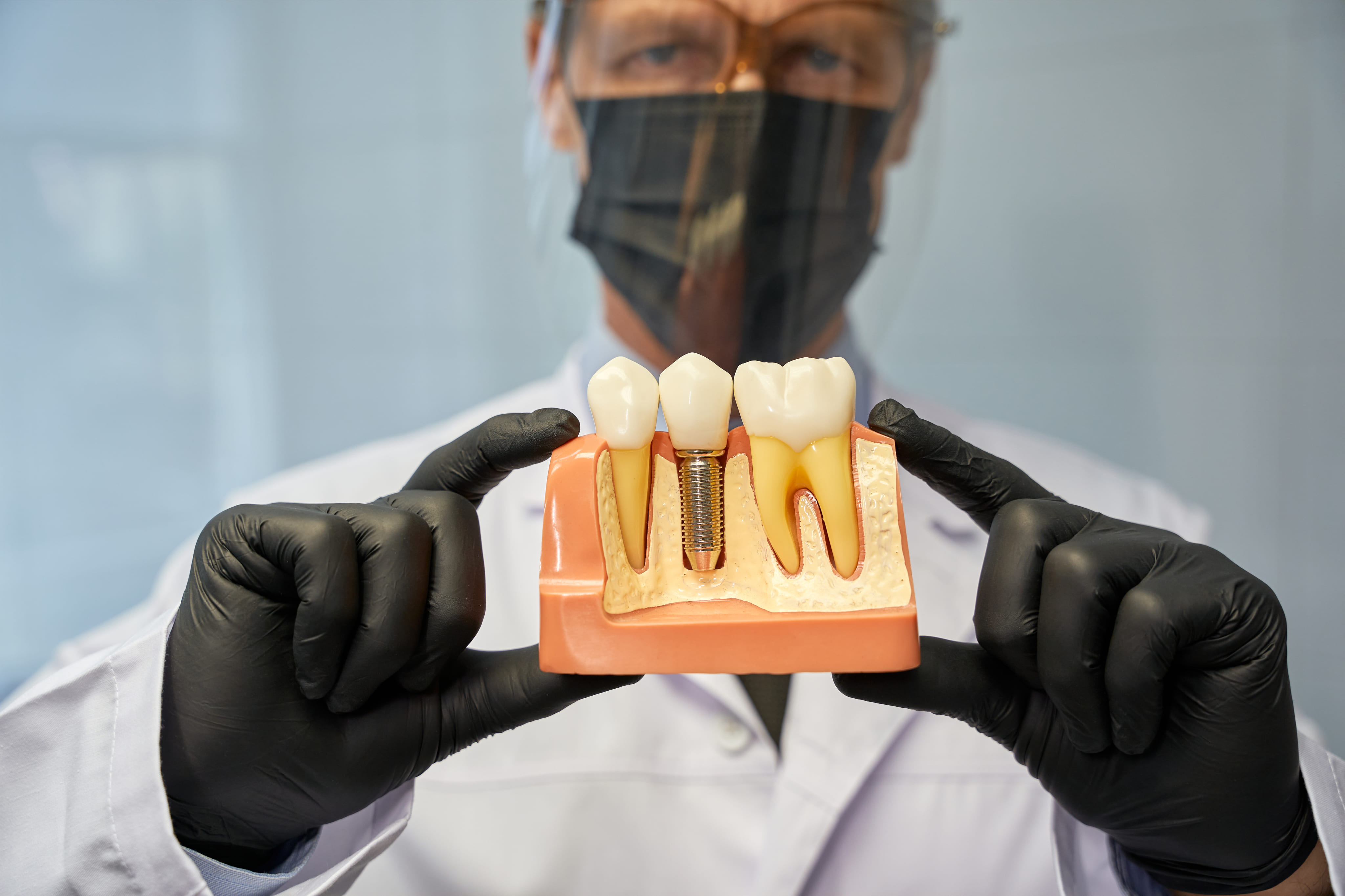 Modèle d'implants dentaires